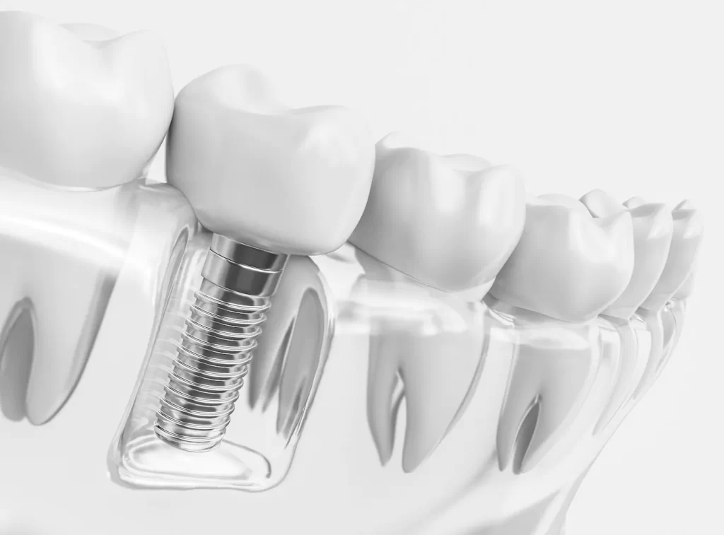 Advanced-Dental-Implants-harshana dental care dindigul