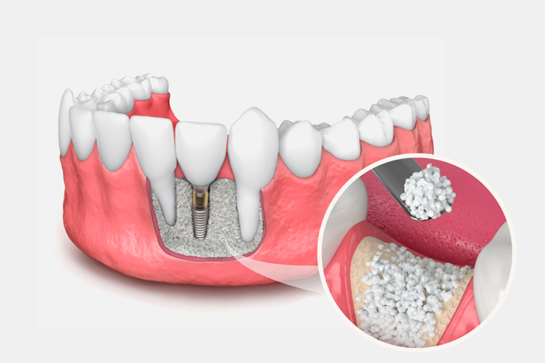 bone grafting harshana dental care dindigul