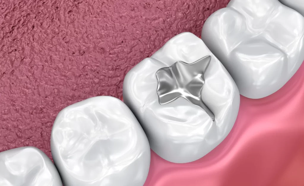 Pit-Fissure-harshana dental care dindigul